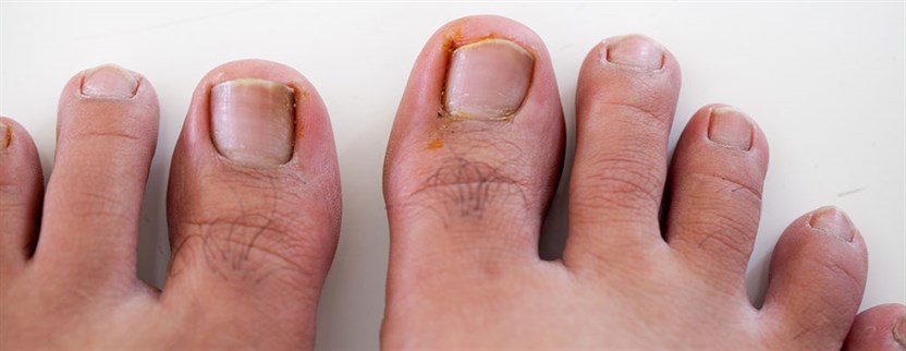 https://www.edmontonfootclinic.com/media/1061/ingrown-stock_832x322.jpg