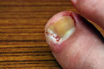 9 Effective Ways to Treat an Ingrown Toenail Permanently - CuraFoot.in