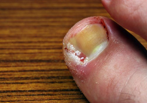 Ingrown toenail placeholder.jpg