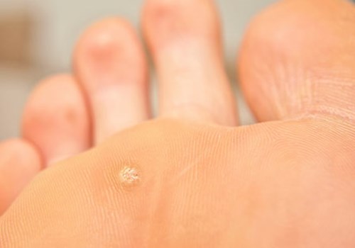 warts.jpg warts.jpg