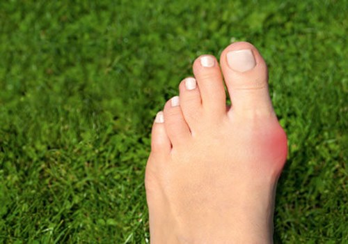 bunion-surgery.jpg bunion-surgery.jpg
