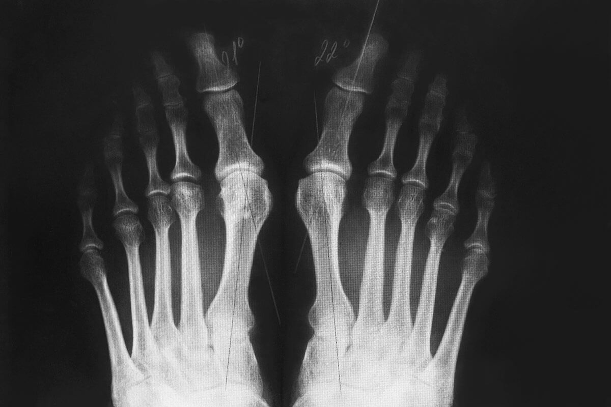 bunion xray