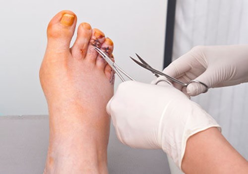 foot-surgery.jpg foot-surgery.jpg